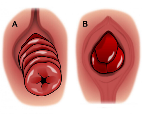 Prolapse,Pelvic Organ Prolapse in Borivali, Mumbai | Uterine Prolapse Treatment