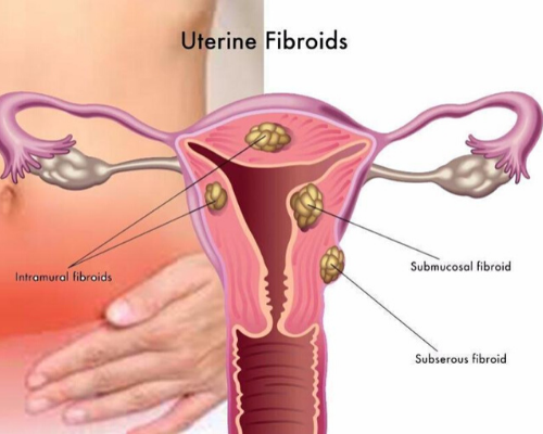 Uterine Fibroid