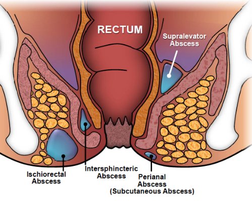 Fistula & piles treatment