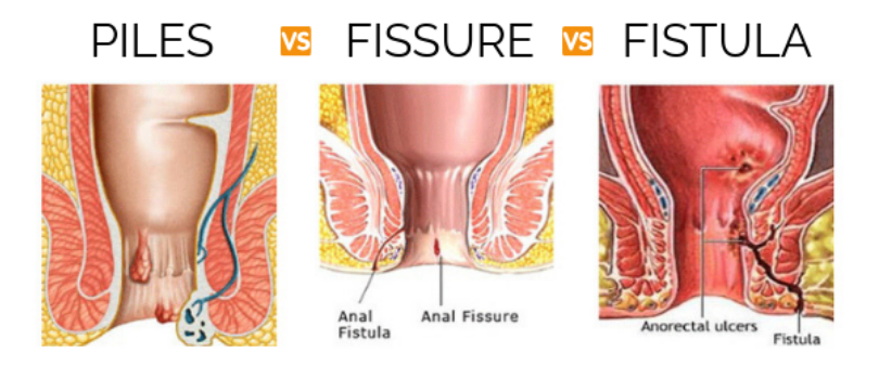 Piles | Fissure | Fistula