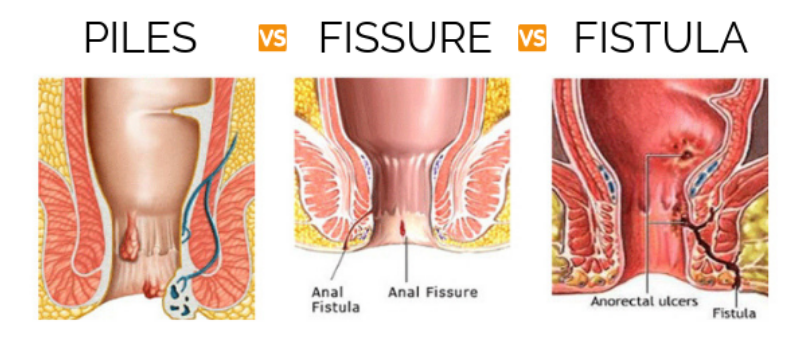 Piles Specialist In Borivali Fissure Fistula Dhanvantari Hospital