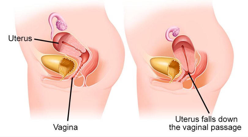 UTERINE - fallen uterus -  - All About Vaginal Rejuvenation