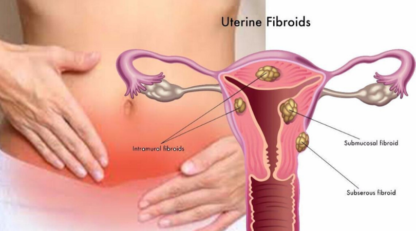 Uterine Fibroid,Uterine Fibroid Treatment In Borivali, Mumbai | Fibroid Treatment Borivali