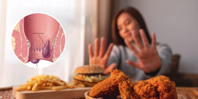 Foods Should You Avoid for Piles